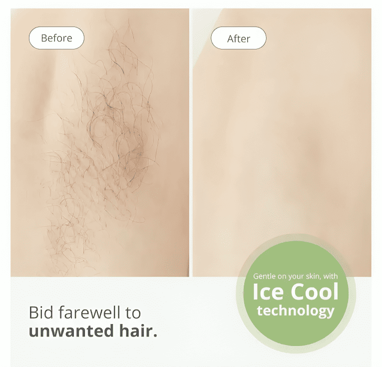 Lescolton Infinity Ice Effect II – Laser Hair Removal with 6-Year Warranty Powered by Elos Me Tech - Free Shipping. - Image 10